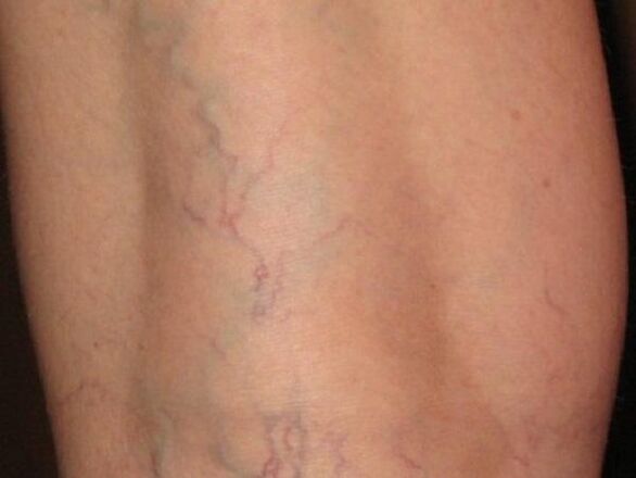 Tipo de varices