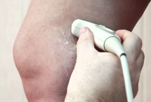 Diagnóstico de varices