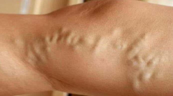 Varices