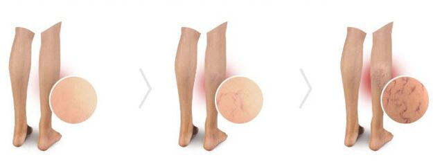 Varices