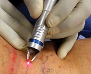 Como se realiza o tratamento con láser das varices