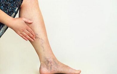 Como tratar as varices das extremidades inferiores