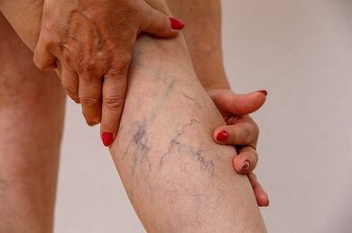 Varices das extremidades inferiores