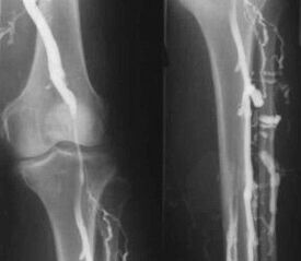 Opcións de diagnóstico para varices das extremidades